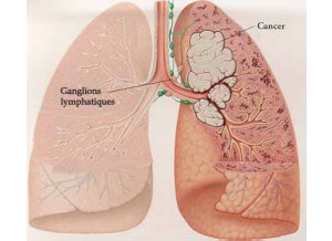 Cancer poumon